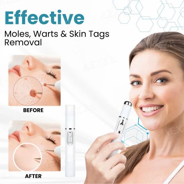 Xorita Non-Invasive Mole and Wart Removal Pen