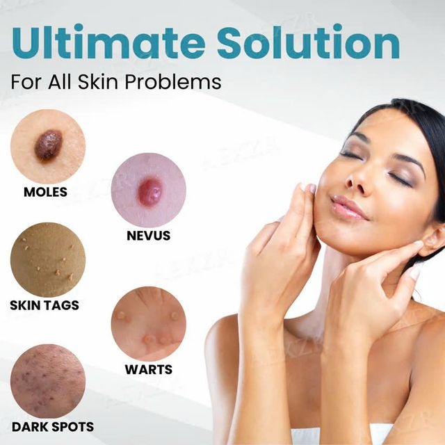 Xorita Non-Invasive Mole and Wart Removal Pen